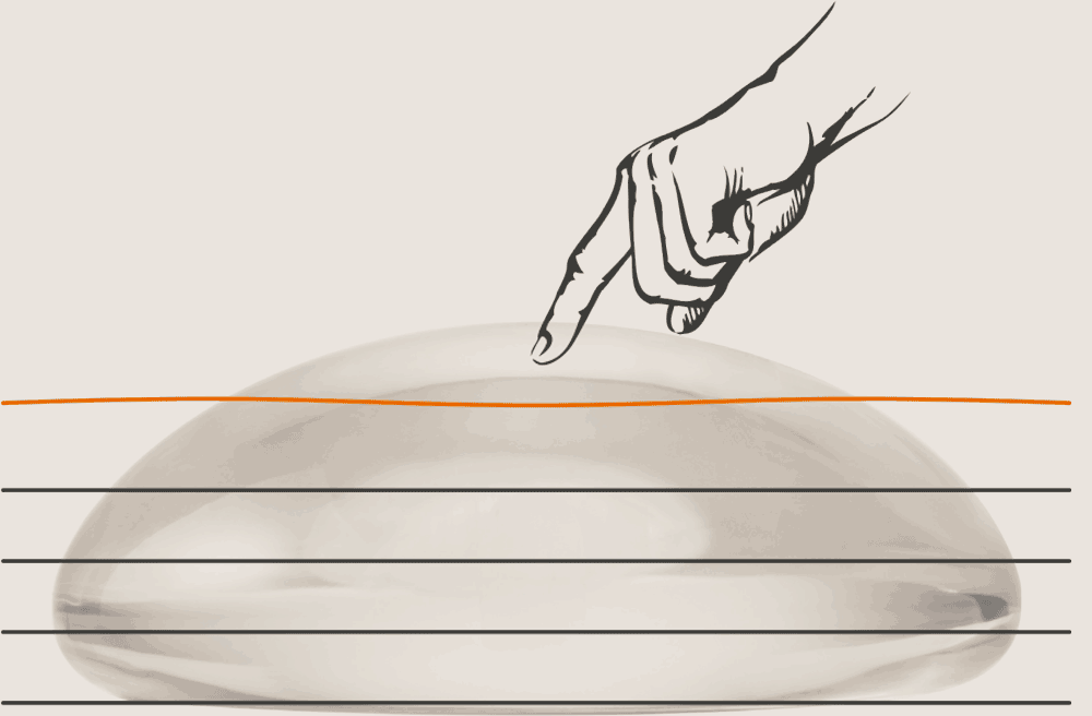 animation d’une main avec le doigt qui appuie sur les lignes pour montrer la fermeté de l’implant