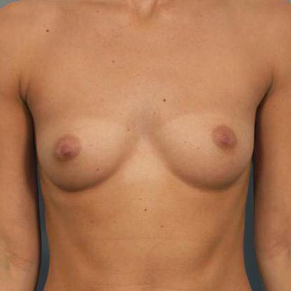 patient facing view before moderate projection breast implant dr cohen