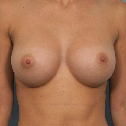 patient facing view after moderate projection breast implant dr cohen