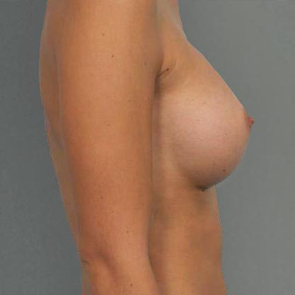 vue de profil de la patiente après les implants mammaires à projection modérée, Dr Cohen