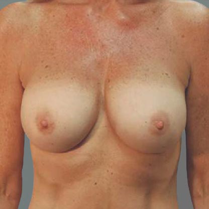 patient frontal view after low projection breast implant dr grotting