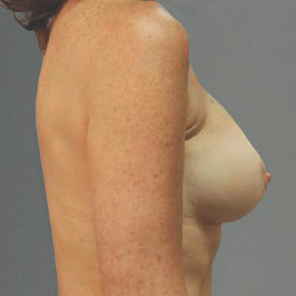 vue du profil de la patiente après les implants mammaires à projection faible, Dr Grotting