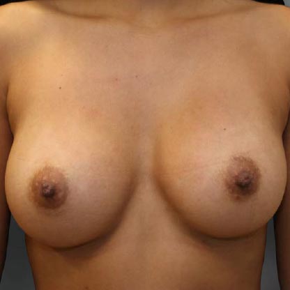 patient facing view after moderate plus projection breast implants dr waltzman