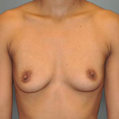 patient front view before high projection breast implants dr smith