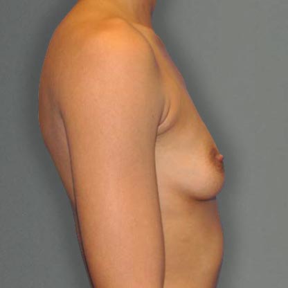 vue de profil de la patiente avant les implants mammaires à projection élevée, Dr Smith